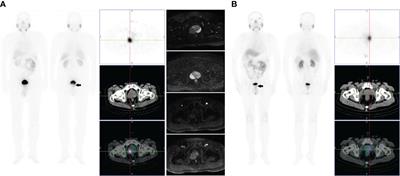 Frontiers Mtc Tc Hynic Alug Spect Ct In The Initial Staging Of